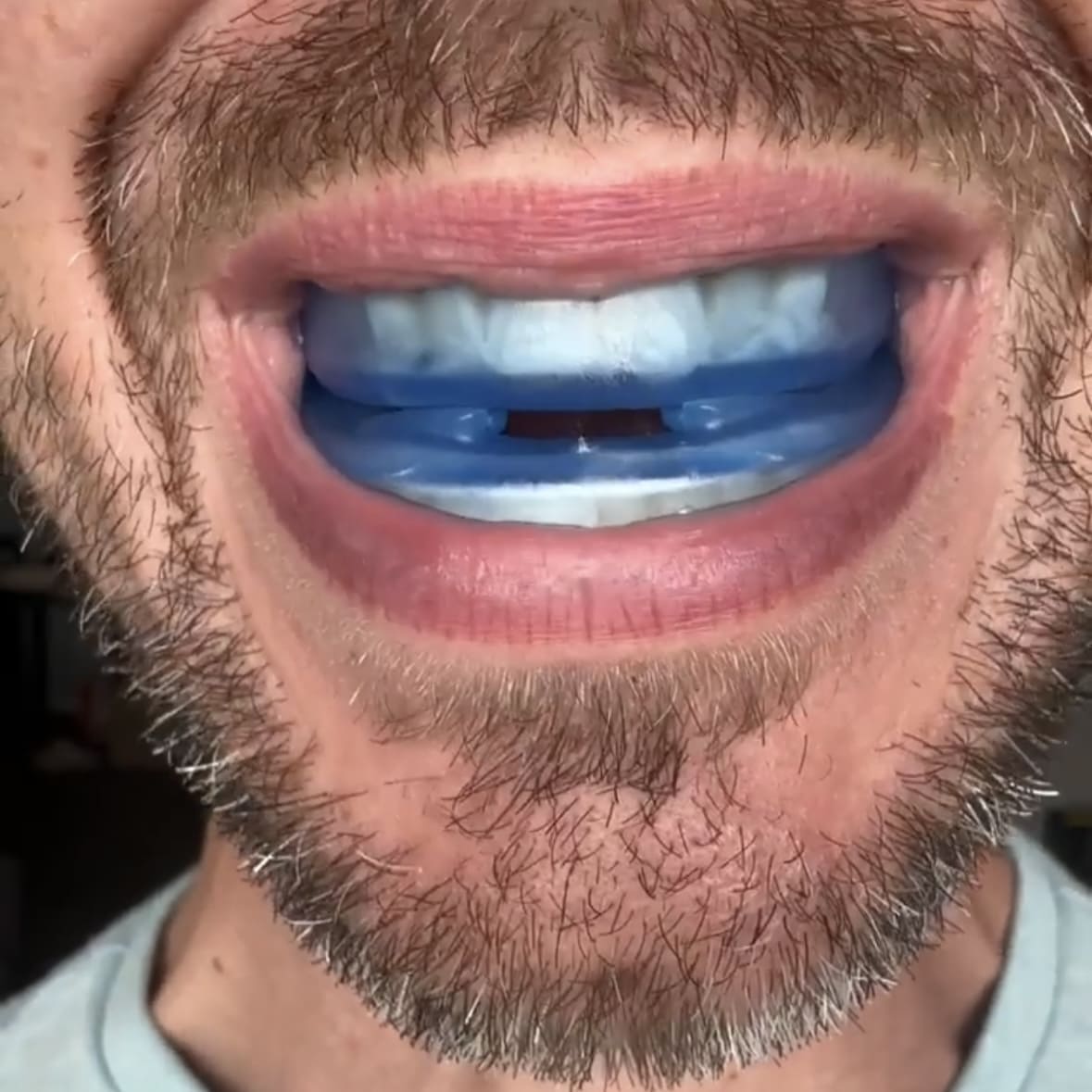 The Quiet Anti-Snoring Mouthpiece Universal Size 50% OFF Today